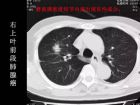 肺内孤立性小结节的CT诊断探析