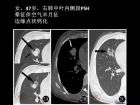 肺内孤立性小结节的CT诊断探析