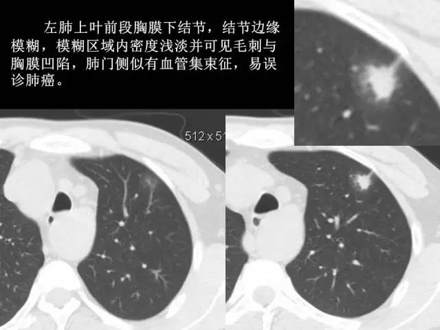 【PPT】肺内孤立性小结节的CT诊断探析