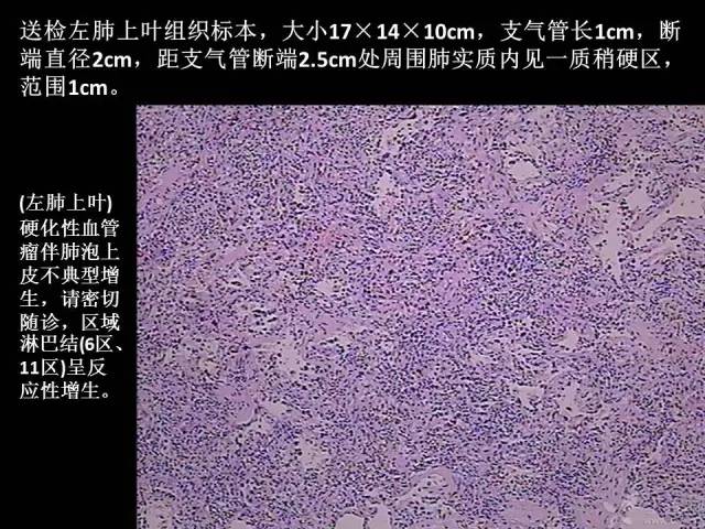 【PPT】肺内孤立性小结节的CT诊断探析
