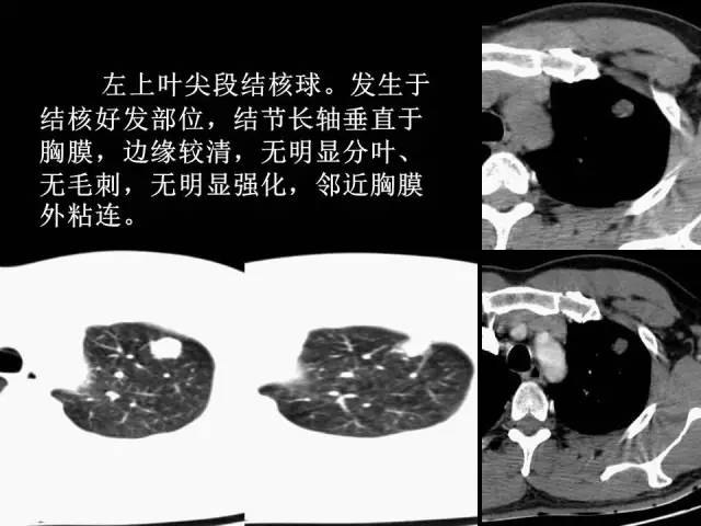【PPT】肺内孤立性小结节的CT诊断探析