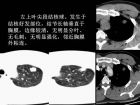 肺内孤立性小结节的CT诊断探析