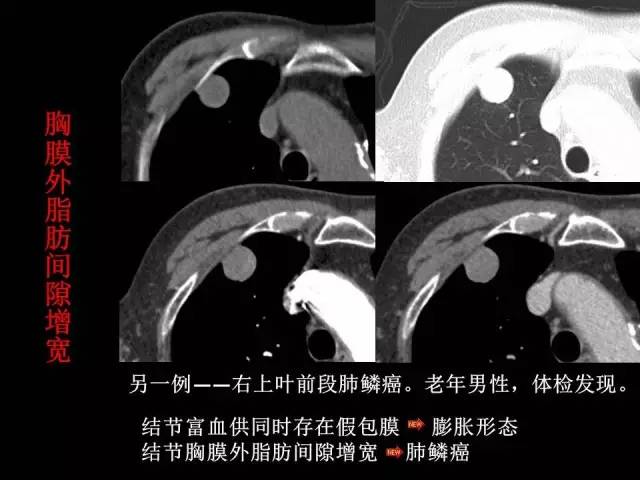 【PPT】肺内孤立性小结节的CT诊断探析