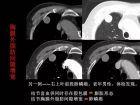 肺内孤立性小结节的CT诊断探析