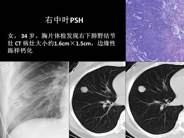 【PPT】肺内孤立性小结节的CT诊断探析