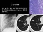 肺内孤立性小结节的CT诊断探析