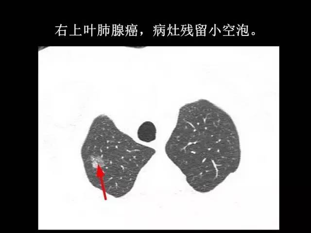 【PPT】肺内孤立性小结节的CT诊断探析