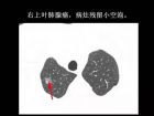 肺内孤立性小结节的CT诊断探析