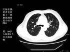 肺内孤立性小结节的CT诊断探析