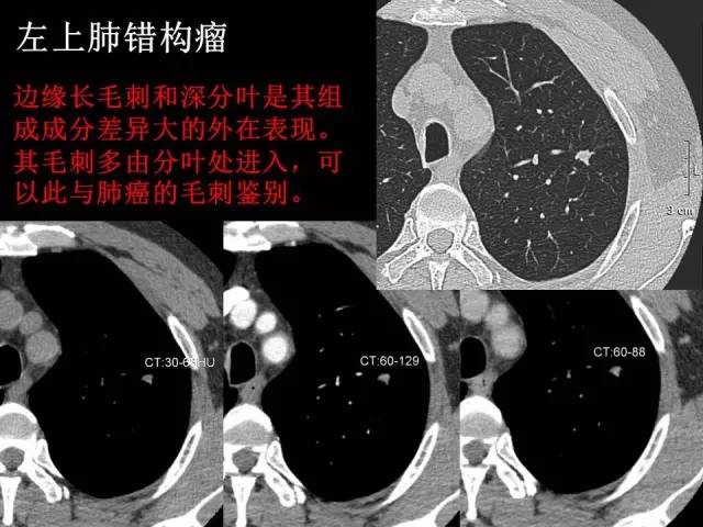 【PPT】肺内孤立性小结节的CT诊断探析