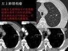 肺内孤立性小结节的CT诊断探析