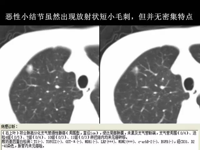 【PPT】肺内孤立性小结节的CT诊断探析