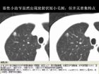 肺内孤立性小结节的CT诊断探析