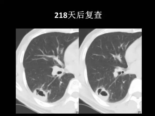 【PPT】肺内孤立性小结节的CT诊断探析