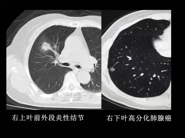 【PPT】肺内孤立性小结节的CT诊断探析