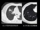 肺内孤立性小结节的CT诊断探析