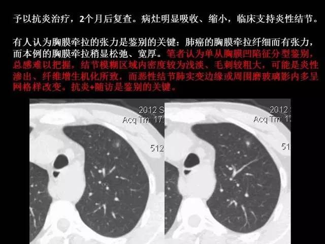 【PPT】肺内孤立性小结节的CT诊断探析