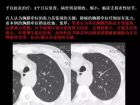 肺内孤立性小结节的CT诊断探析