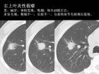 肺内孤立性小结节的CT诊断探析