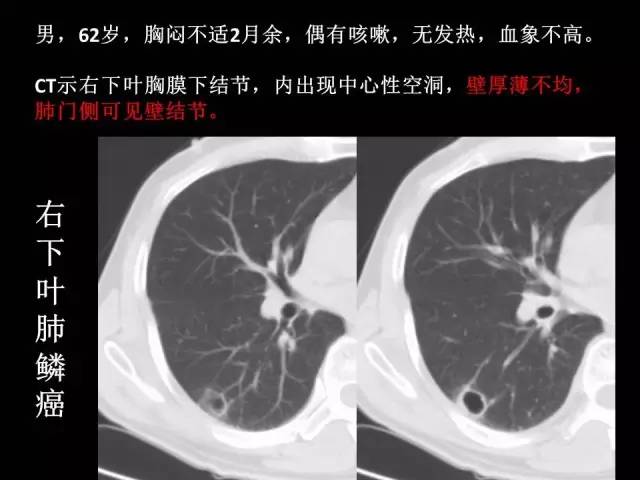 【PPT】肺内孤立性小结节的CT诊断探析