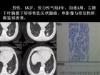 肺内孤立性小结节的CT诊断探析