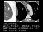 肺内孤立性小结节的CT诊断探析