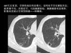 肺内孤立性小结节的CT诊断探析