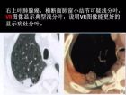 肺内孤立性小结节的CT诊断探析