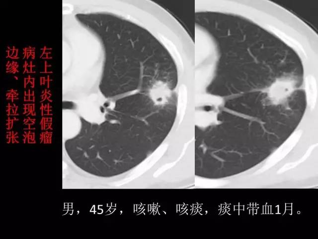 【PPT】肺内孤立性小结节的CT诊断探析