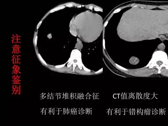 【PPT】肺内孤立性小结节的CT诊断探析
