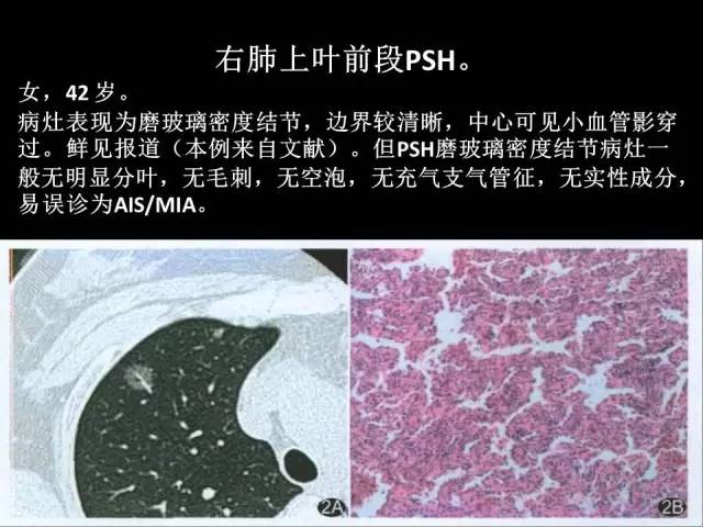 【PPT】肺内孤立性小结节的CT诊断探析