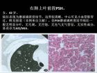 肺内孤立性小结节的CT诊断探析