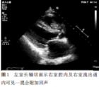 超声造影诊断右室黏液瘤1例