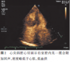 超声造影诊断右室黏液瘤1例