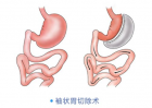 减重手术后复胖的几率有多大？