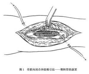 (图)慢性血源性骨髓炎 (图)慢性血源性骨髓炎