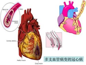 冠心病 冠心病