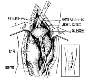 (图)膝关节结核 (图)膝关节结核