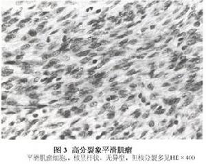 高分裂象平滑肌瘤 高分裂象平滑肌瘤