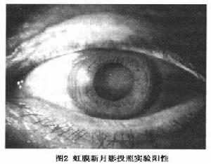 年龄相关性白内障 年龄相关性白内障