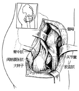 髋关节结核 髋关节结核