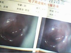 宫颈息肉 宫颈息肉