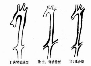 多发性大动脉炎 多发性大动脉炎