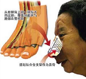 鼻血管瘤 鼻血管瘤