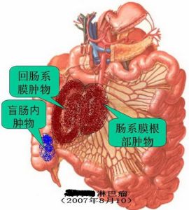 小肠肿瘤 小肠肿瘤