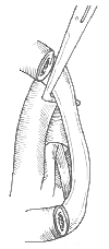 胸廓出口综合征野猫头鹰