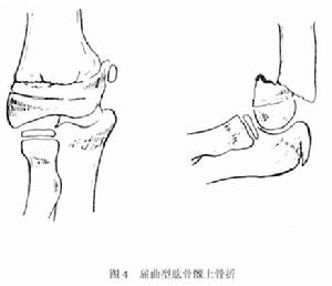 肱骨髁上骨折 肱骨髁上骨折