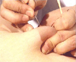 急性胆囊炎 急性胆囊炎