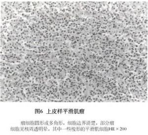 上皮样平滑肌瘤 上皮样平滑肌瘤
