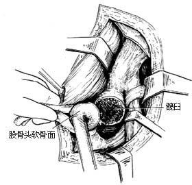 髋关节结核 髋关节结核